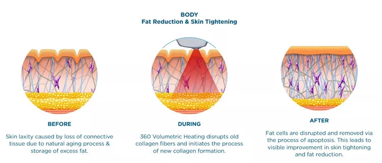 2026 The Latest Model Newly Upgraded RF Skin Firming Machine Degreasing Shrinking Pores Wrinkle Removal No Damage