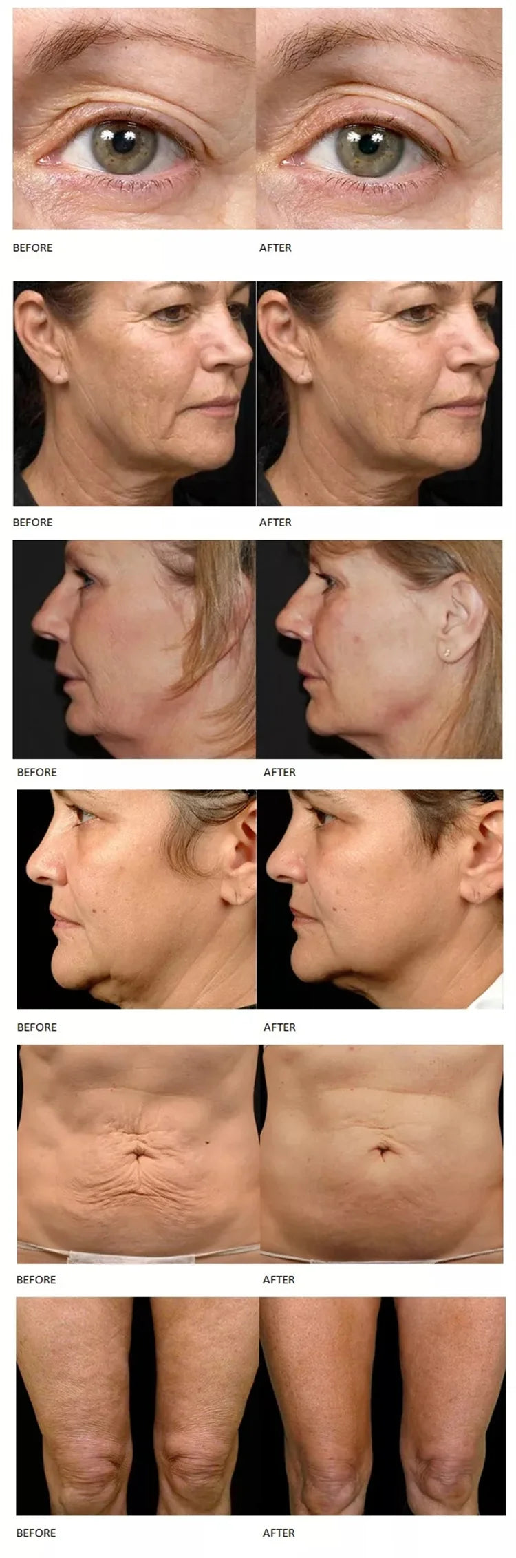 2026 The Latest Model Newly Upgraded RF Skin Firming Machine Degreasing Shrinking Pores Wrinkle Removal No Damage