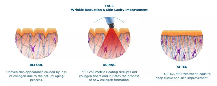 2026 The Latest Model Newly Upgraded RF Skin Firming Machine Degreasing Shrinking Pores Wrinkle Removal No Damage